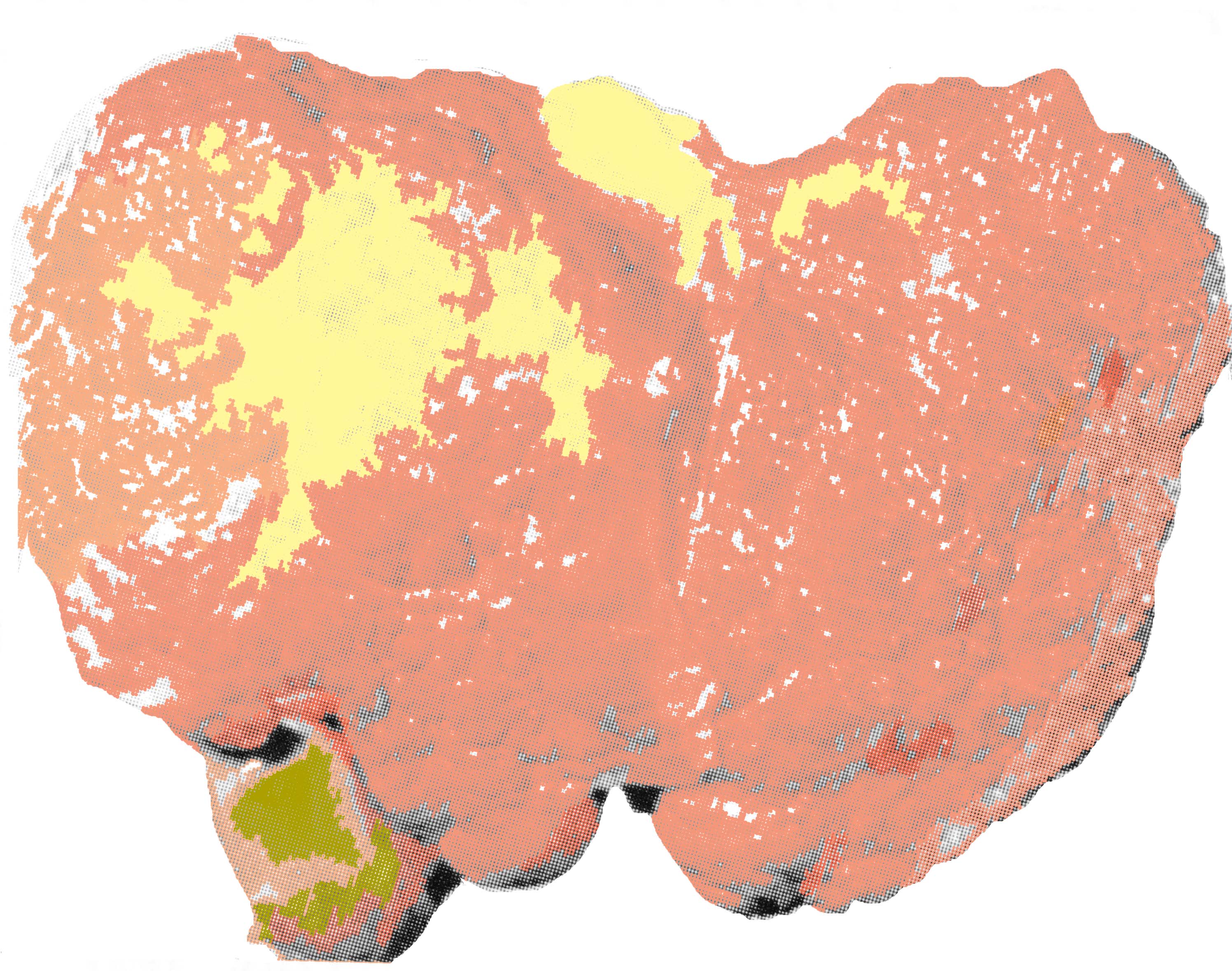Zirrhose